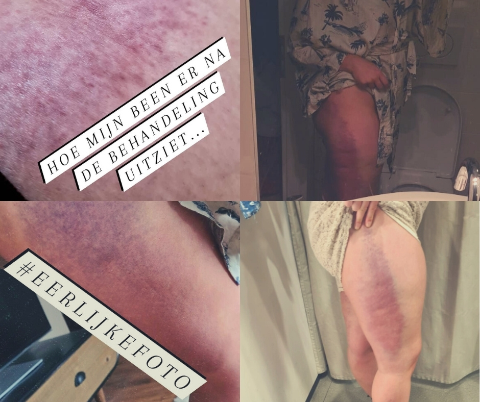 bindweefselmassage anti cellulitis